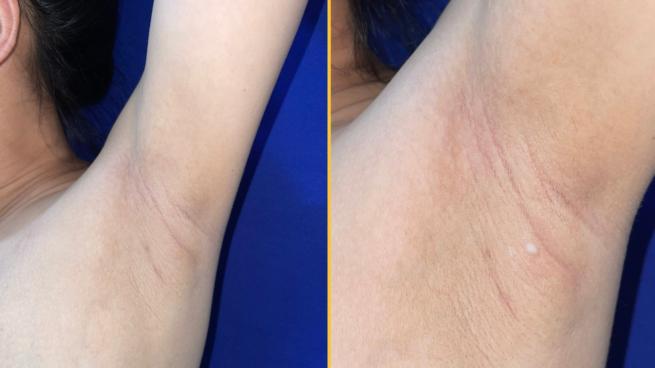 Diagnostic dilemma: Milk leaking from woman’s armpits revealed ‘ectopic breasts’