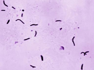 Global tuberculosis diagnoses rise to a record, but deaths fall, WHO reports