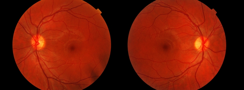 FDA approves novel gene therapy delivery platform for a rare retinal disorder