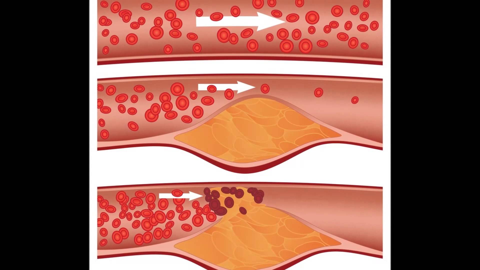 The Cholesterol Wars Continue