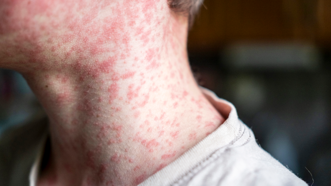 US could lose its measles elimination status within months, experts say
