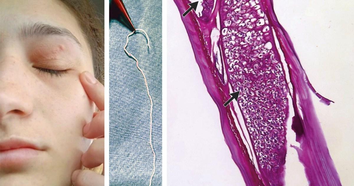 Worm ‘from pet dog’ hatched inside woman’s forehead and then crawled into her eye