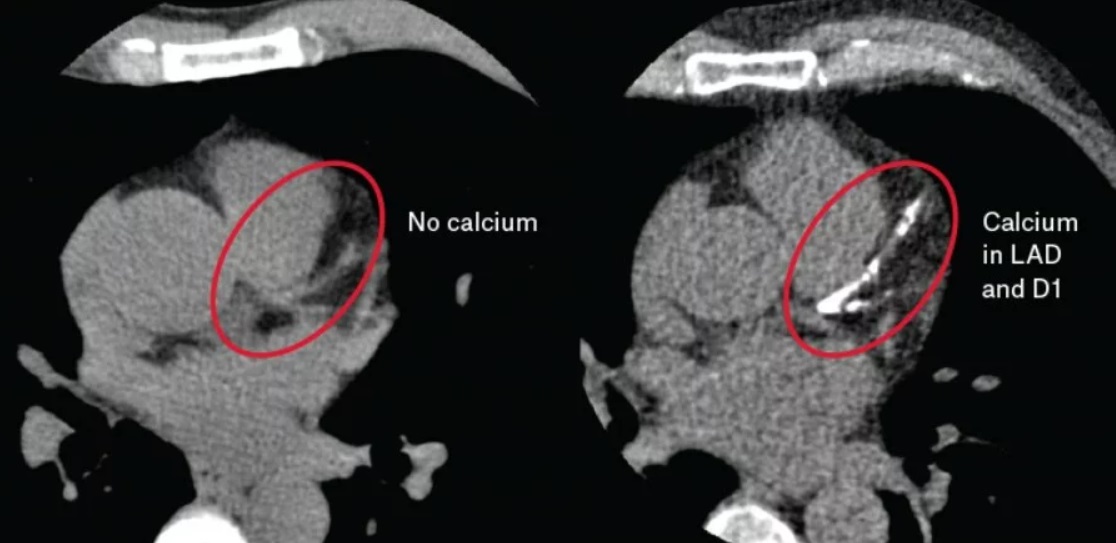 Are Cardiac Calcium CT Scans Useful?