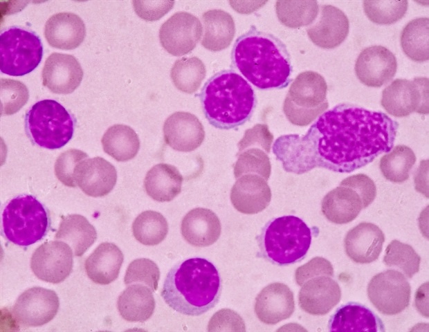 Fixed-duration therapy works as effectively as continuous treatment for chronic lymphocytic leukemia
