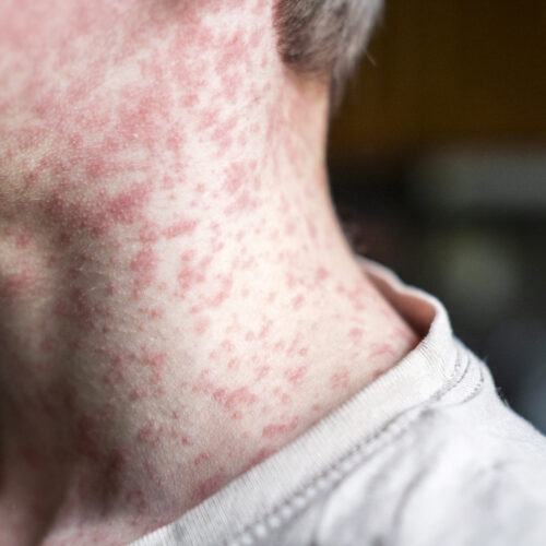 Over 250 people quarantined in South Carolina as measles outbreak rages