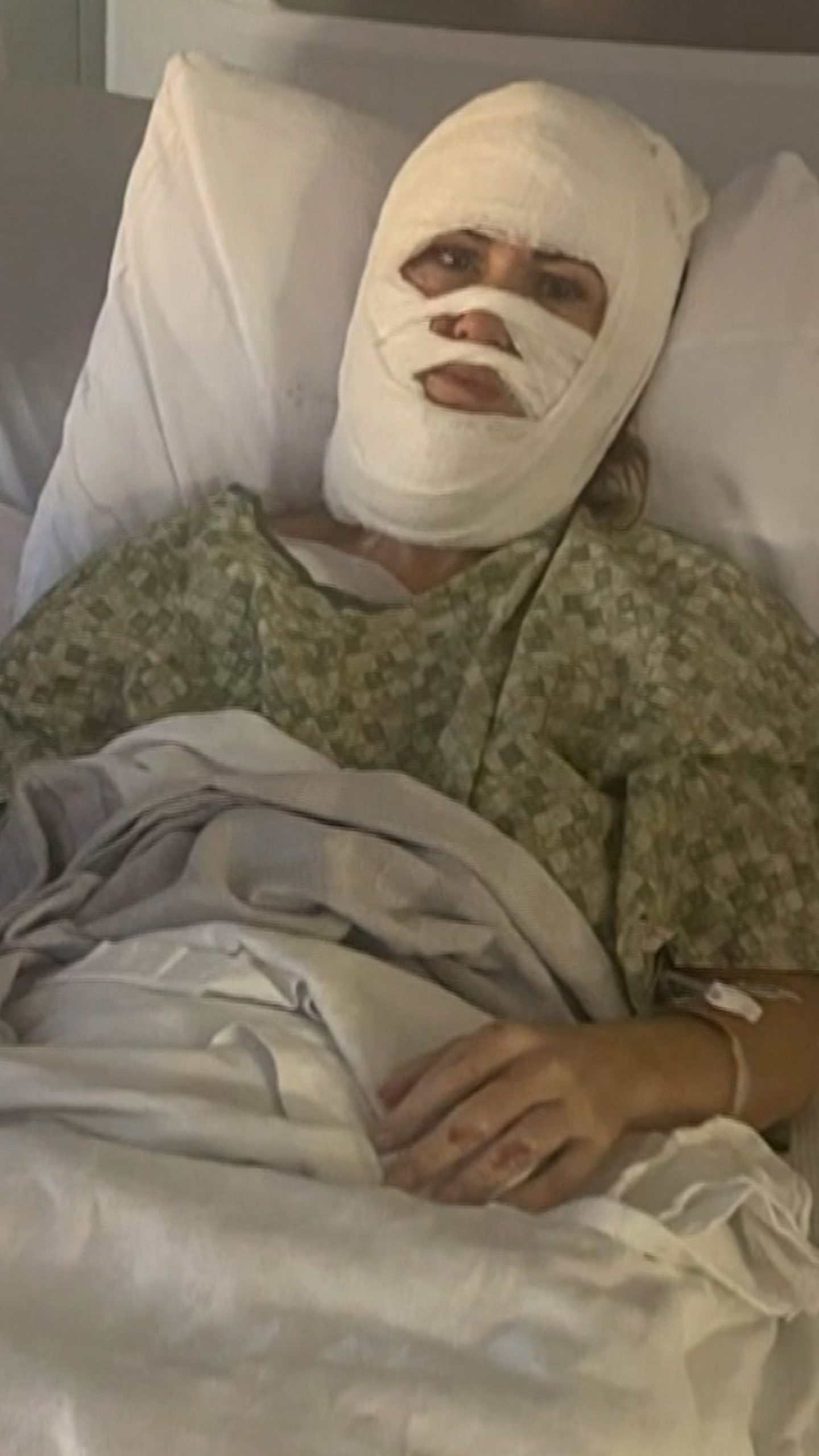 Suspect sought in acid attack on Georgia woman