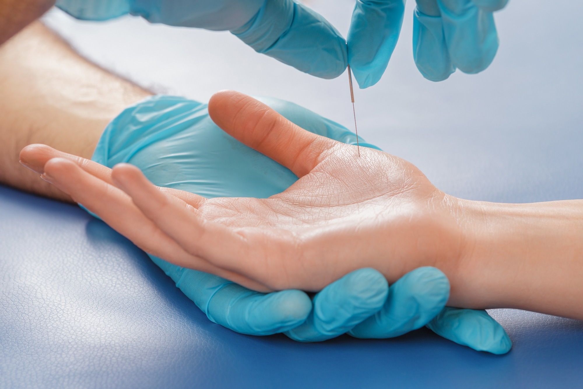 Acupuncture may help ICU patients recover faster