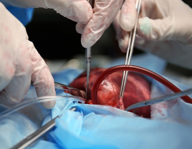 Researchers successfully perform coronary artery bypass without cutting the chest wall