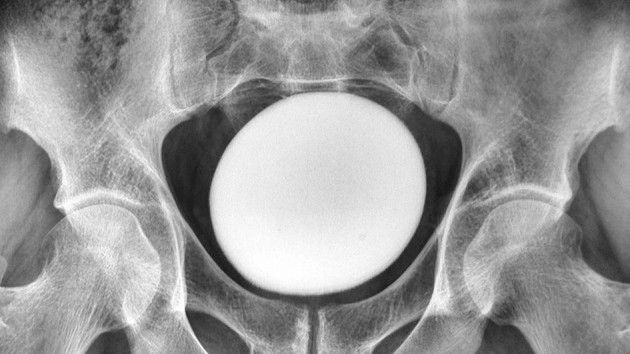 Diagnostic dilemma: Giant ‘stone’ in a man’s bladder looked like an ostrich egg