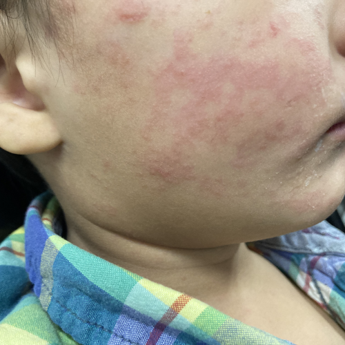 Measles continues raging in South Carolina; 99 new cases since Tuesday