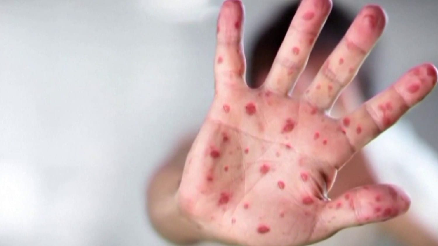 Measles Outbreak in South Carolina Doubles in a Week