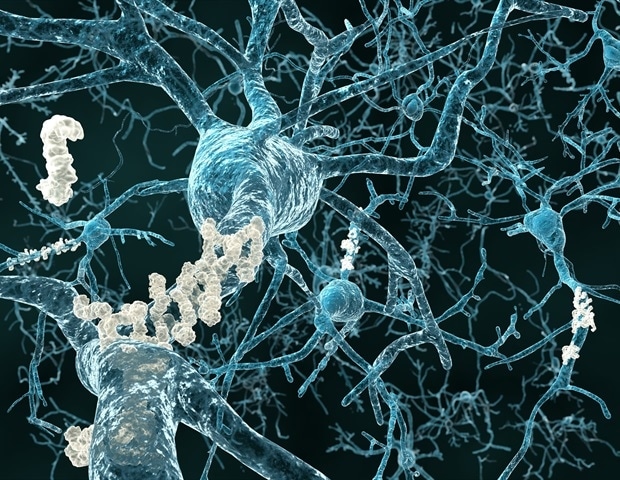 Brain complexity declines in Alzheimer’s disease