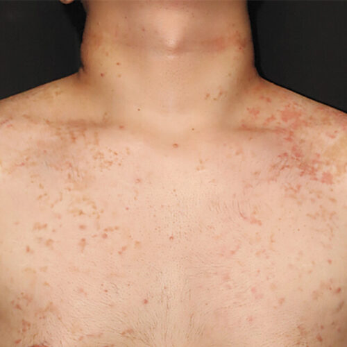 A weird, itchy rash is linked to the keto diet—but no one knows why