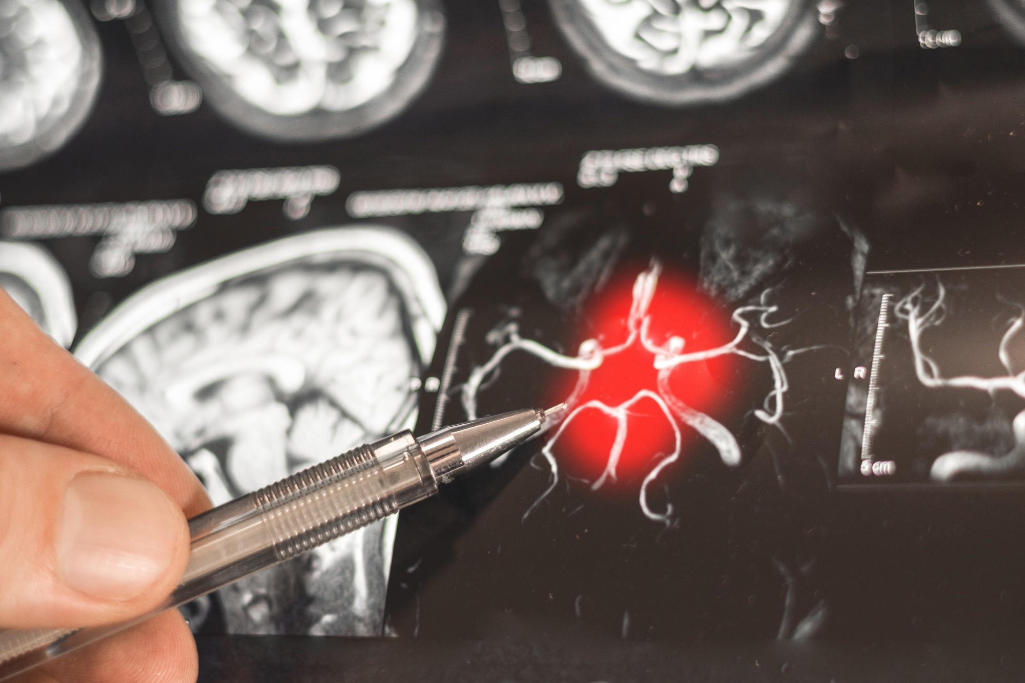 Evidence links gut microbiome changes to Alzheimer’s progression