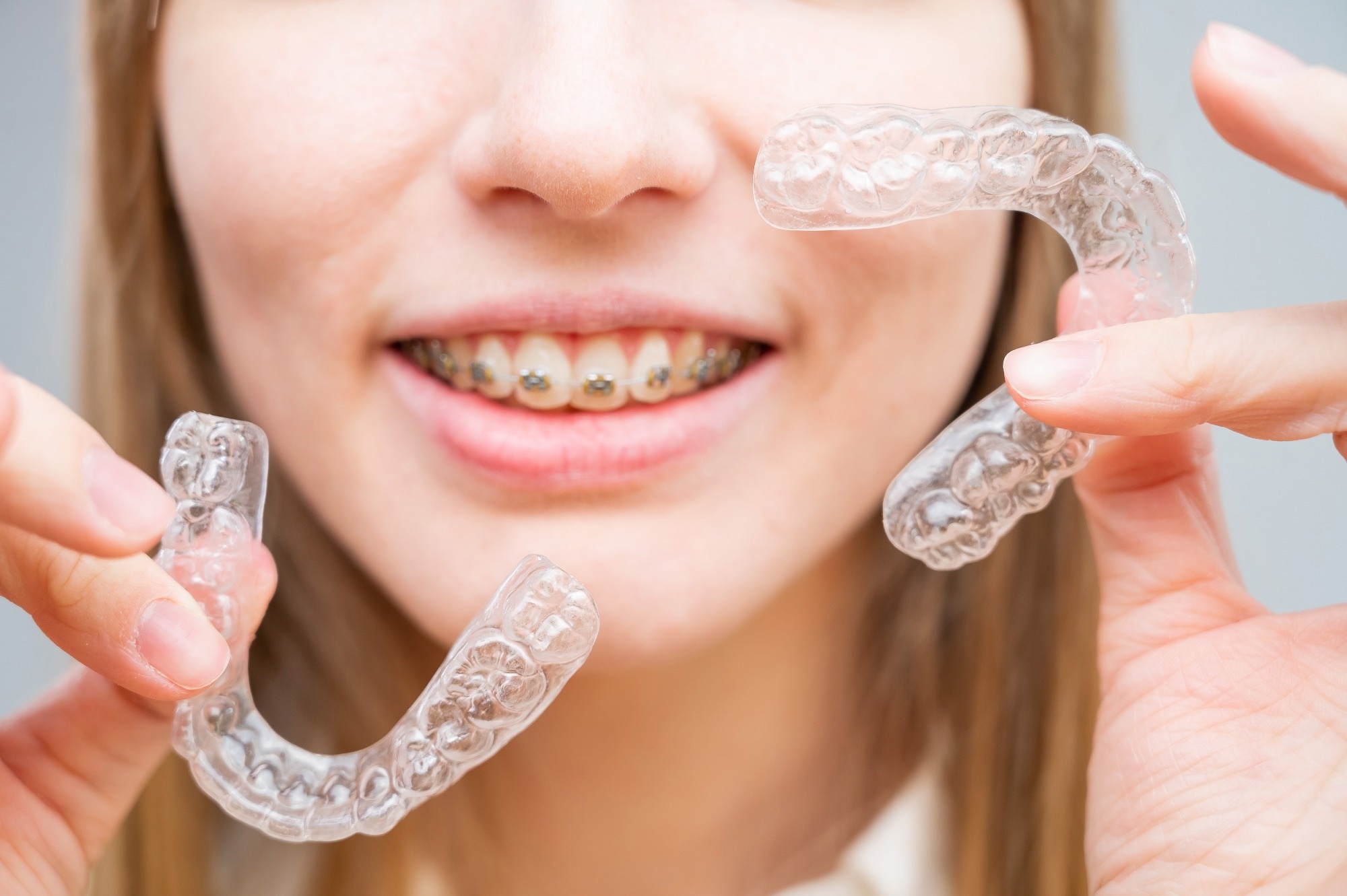 Clear aligners protect oral microbiome better than fixed braces