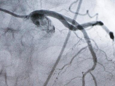 Experimental cholesterol-lowering pill may offer new option for millions