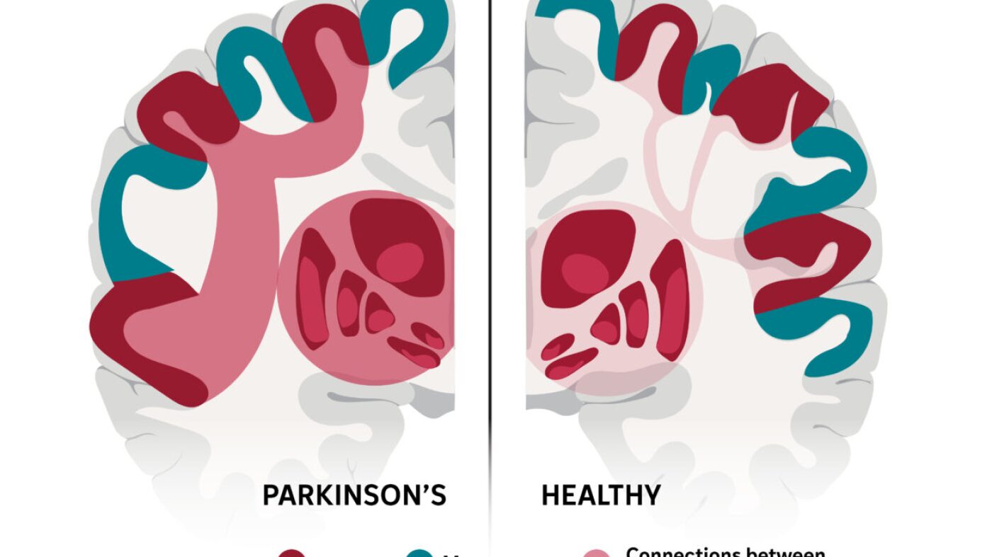 This complex brain network may explain many of Parkinson’s stranger symptoms