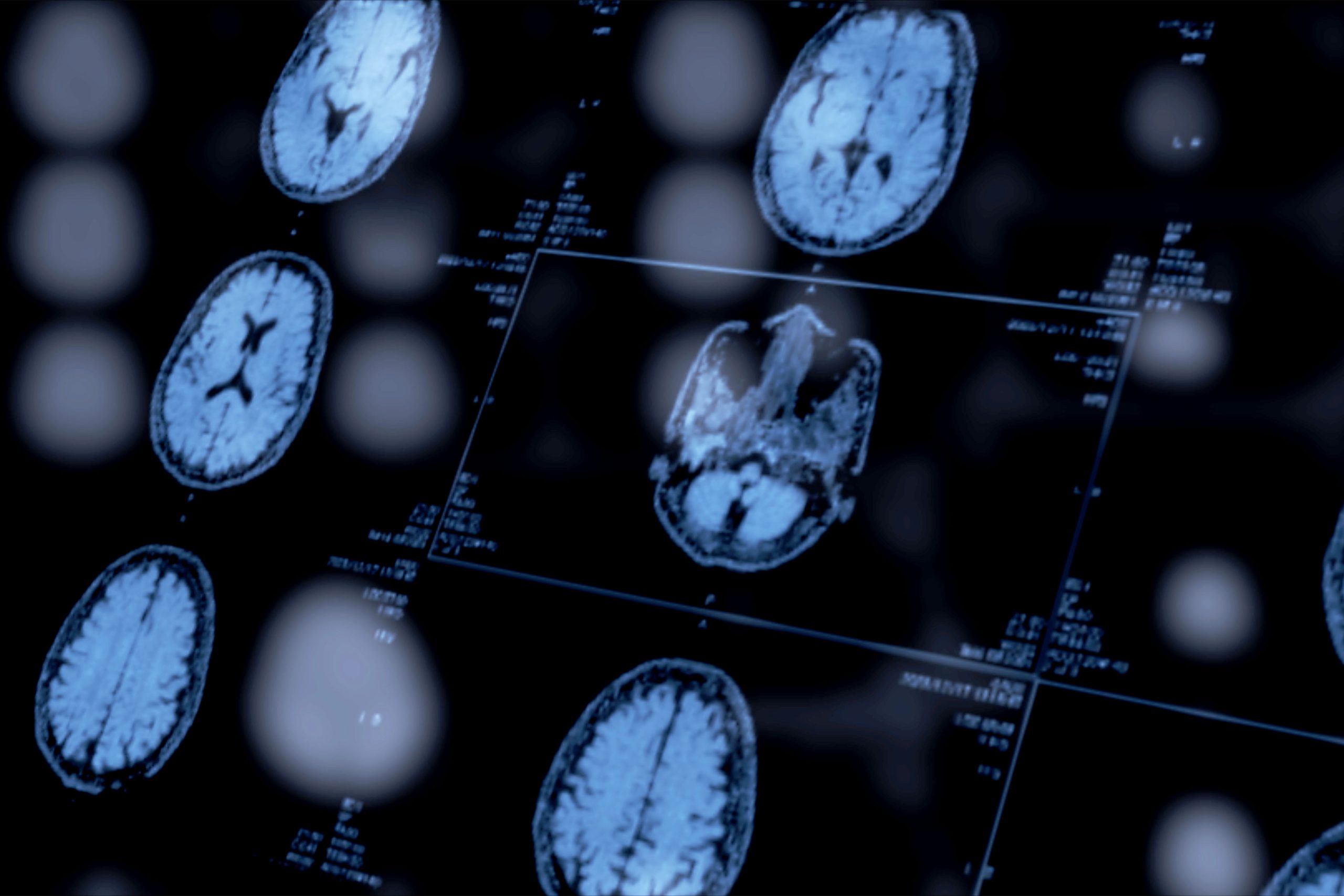 Psychiatrists’ Use of Biomarkers Could Open a New Window Into Mental Health Diagnoses