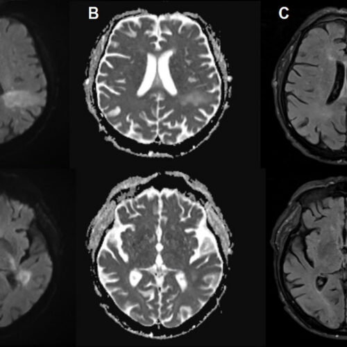 You’re likely already infected with a brain-eating virus you’ve never heard of