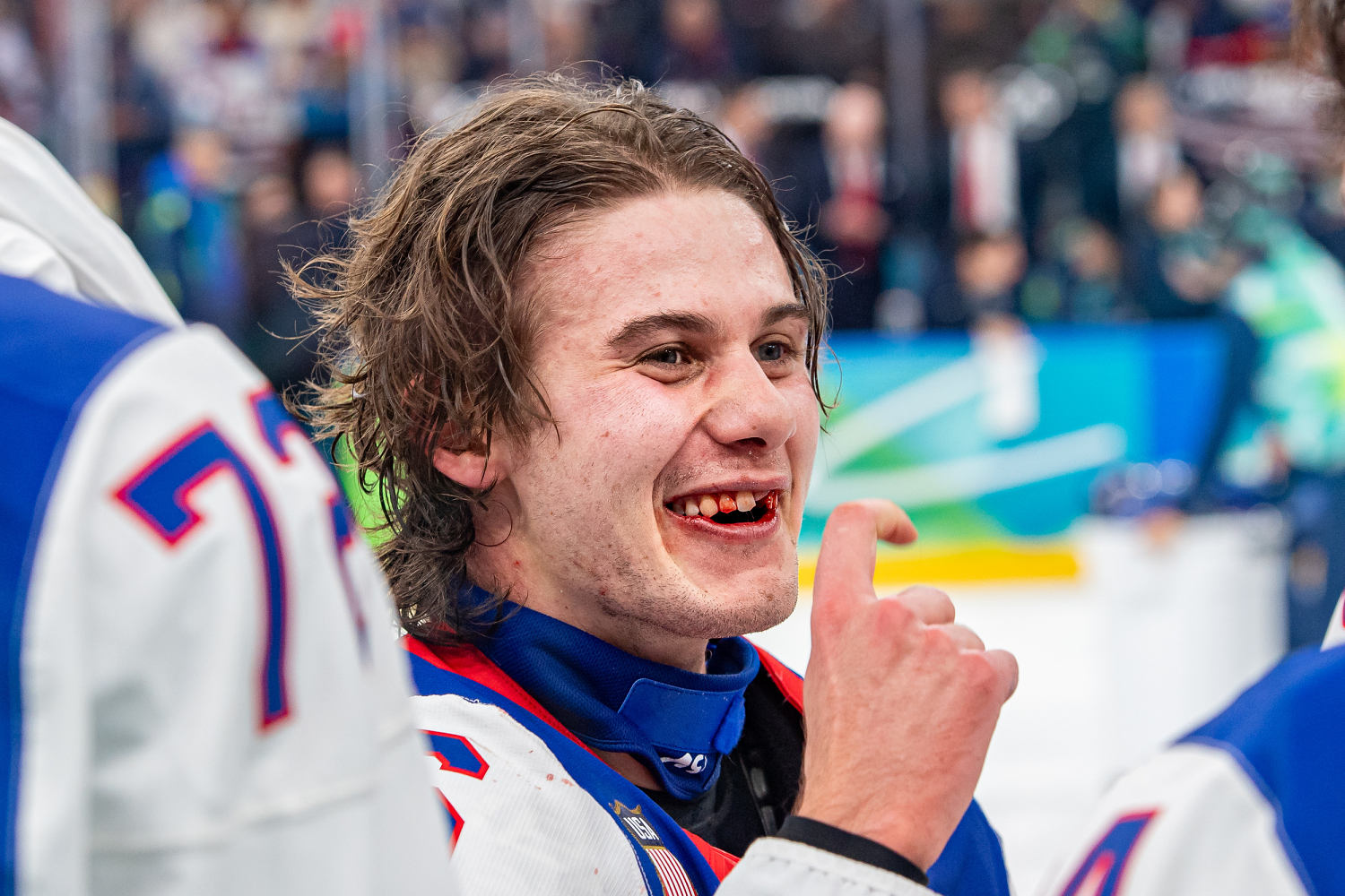U.S. Olympic hockey hero Jack Hughes finally fixes teeth broken in gold medal game