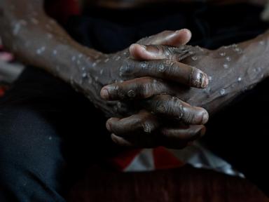 Congo says its mpox outbreak is over after 2 years and more than 2,200 suspected deaths