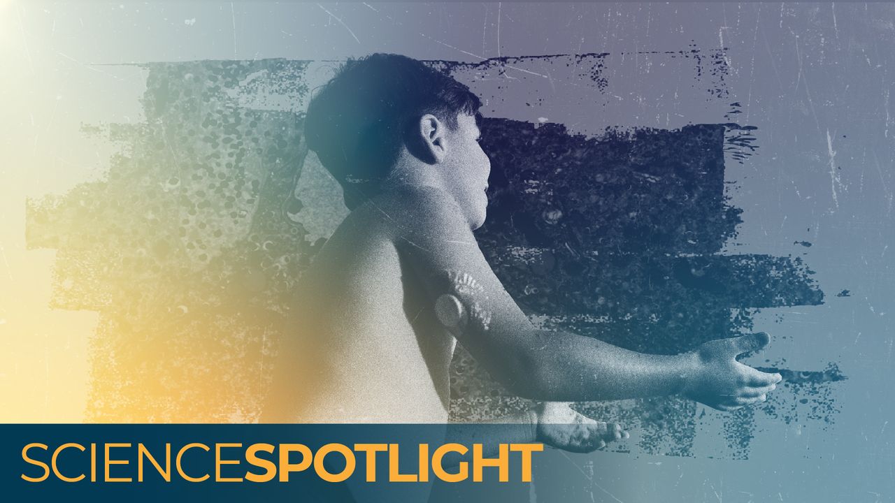 ‘A cure on the horizon’: Are we finally close to ending type 1 diabetes?