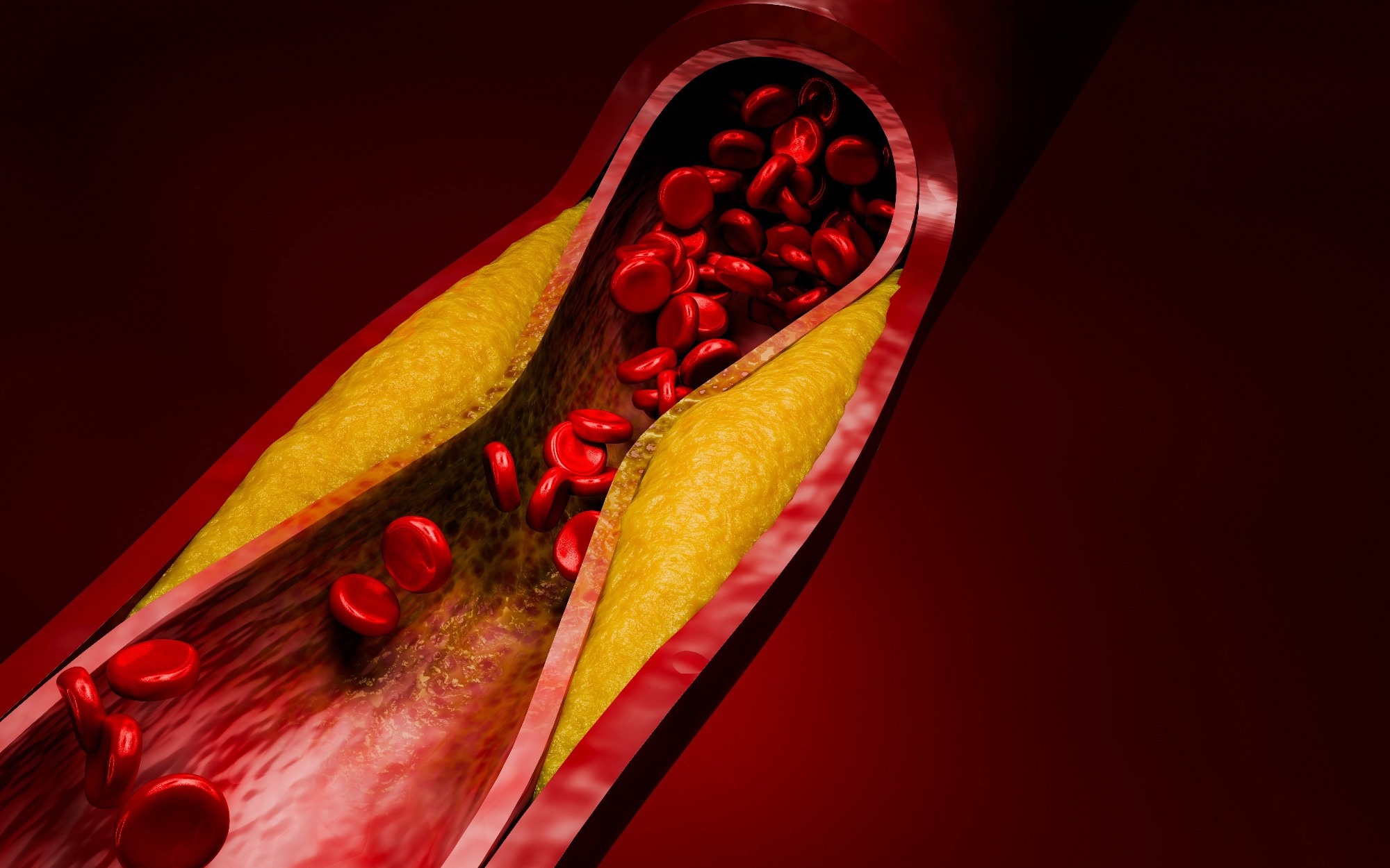 Evolocumab trial could reshape how doctors treat high-risk cholesterol patients