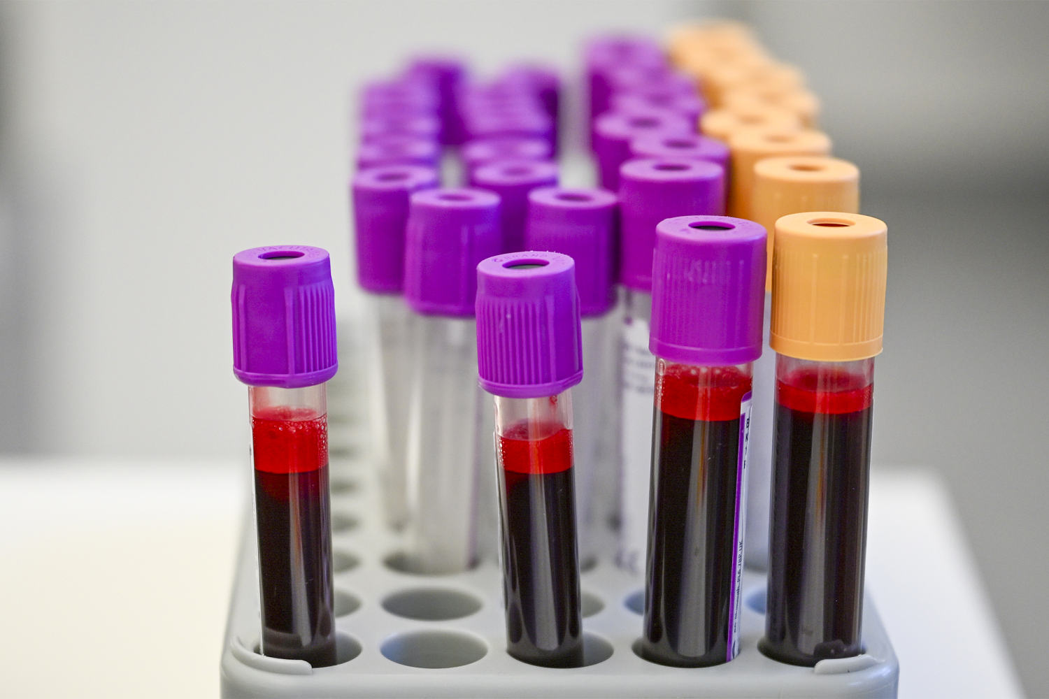 Are cancer-screening blood tests close to prime time?