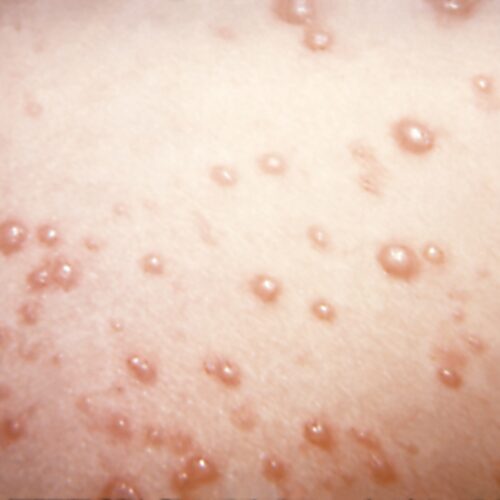 In rare chickenpox case, itchy blisters mushroom into large, rubbery nodules