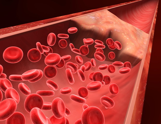 Apixaban reduces complications, helps older adults spend more time at home after blood clots