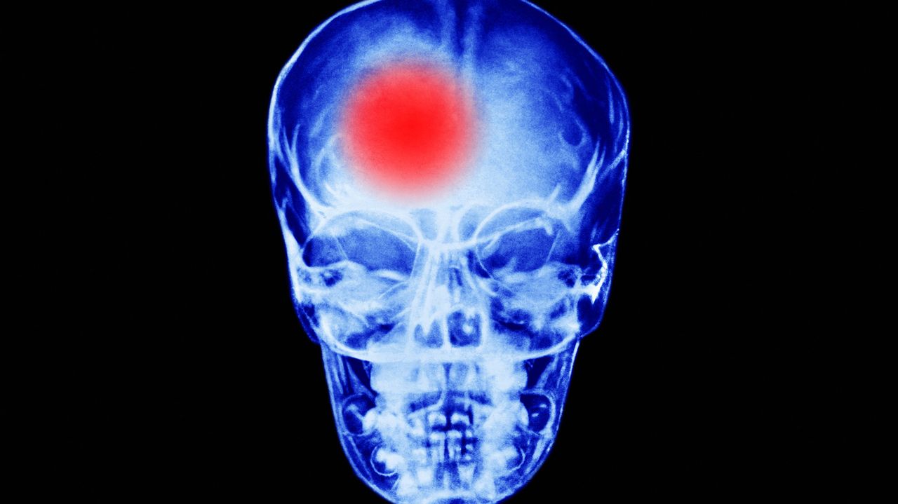 Both very low and very high heart rates may be linked to higher stroke risk, study says
