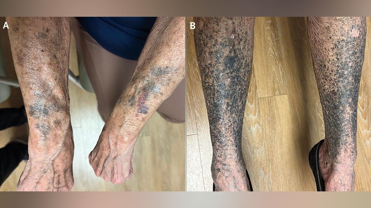 Diagnostic dilemma: A woman turned black and blue weeks after starting a new medication