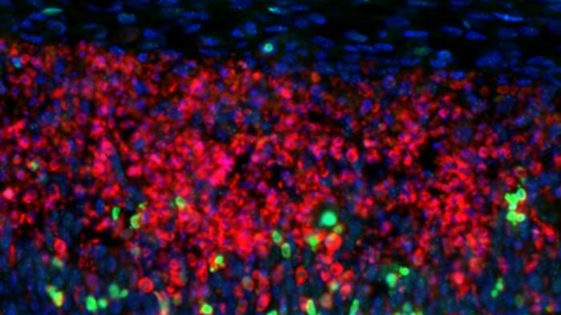 Why some brain cells are particularly vulnerable to multiple sclerosis