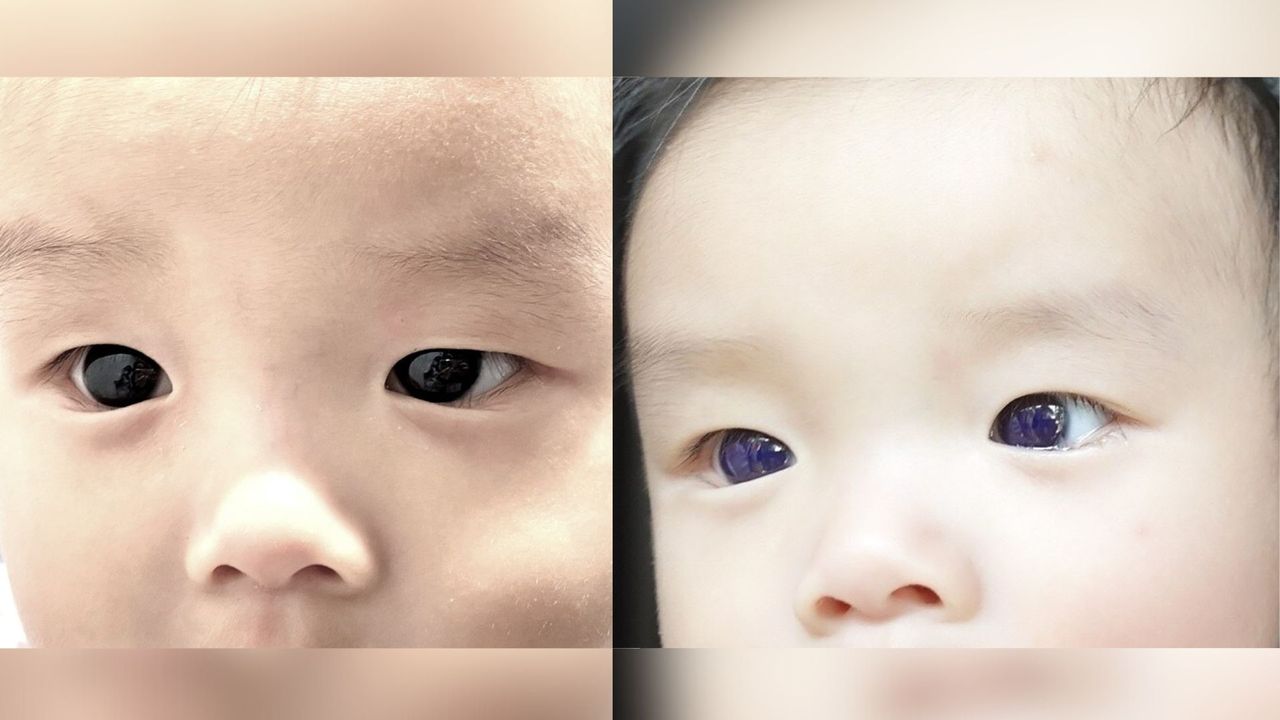 Diagnostic dilemma: An infant’s brown eyes turned indigo after COVID antiviral treatment