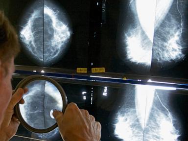 When should you get a mammogram? Conflicting advice makes it hard to know