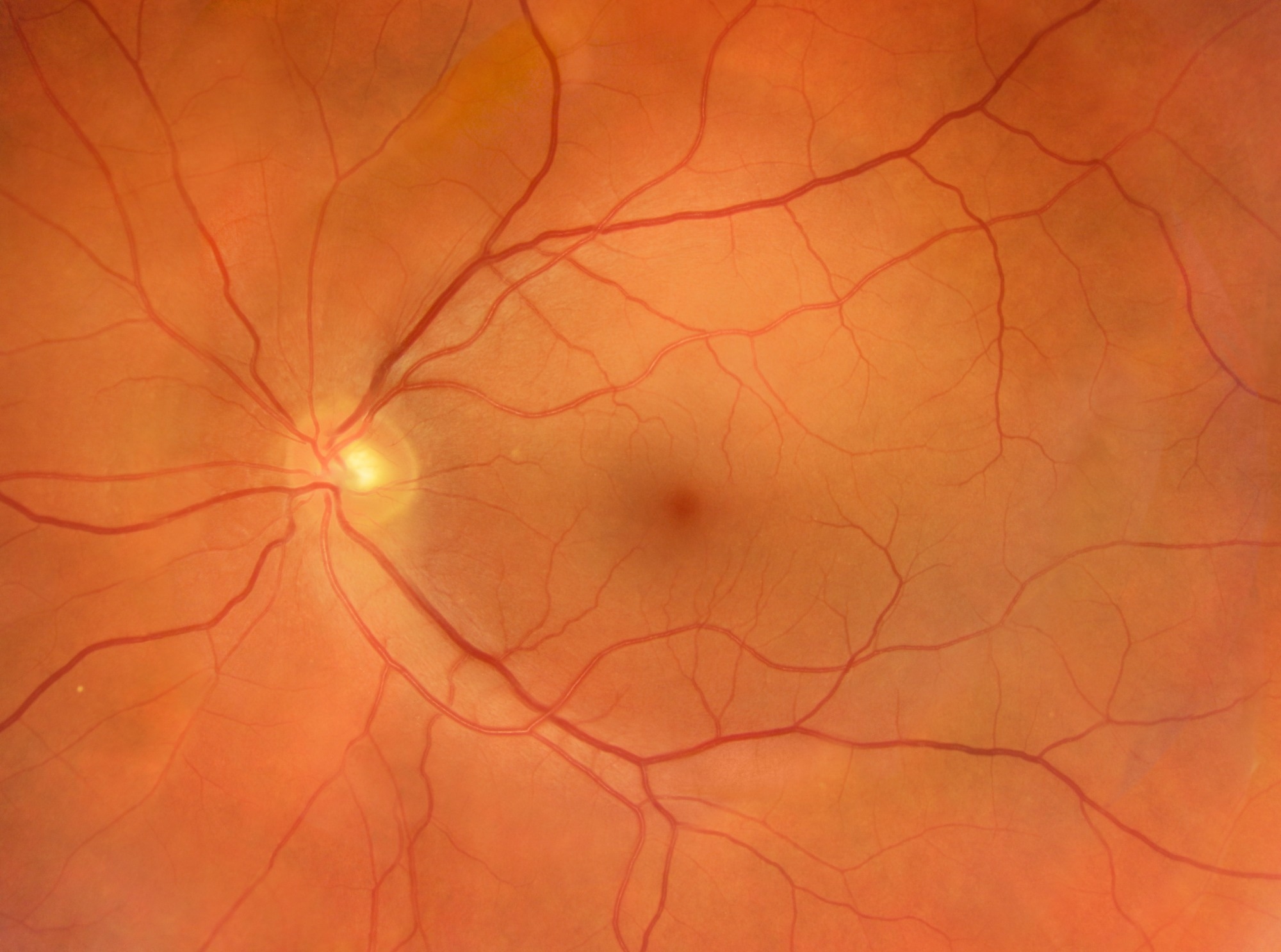 AI eye scans reveal who may be at higher risk of osteoporosis