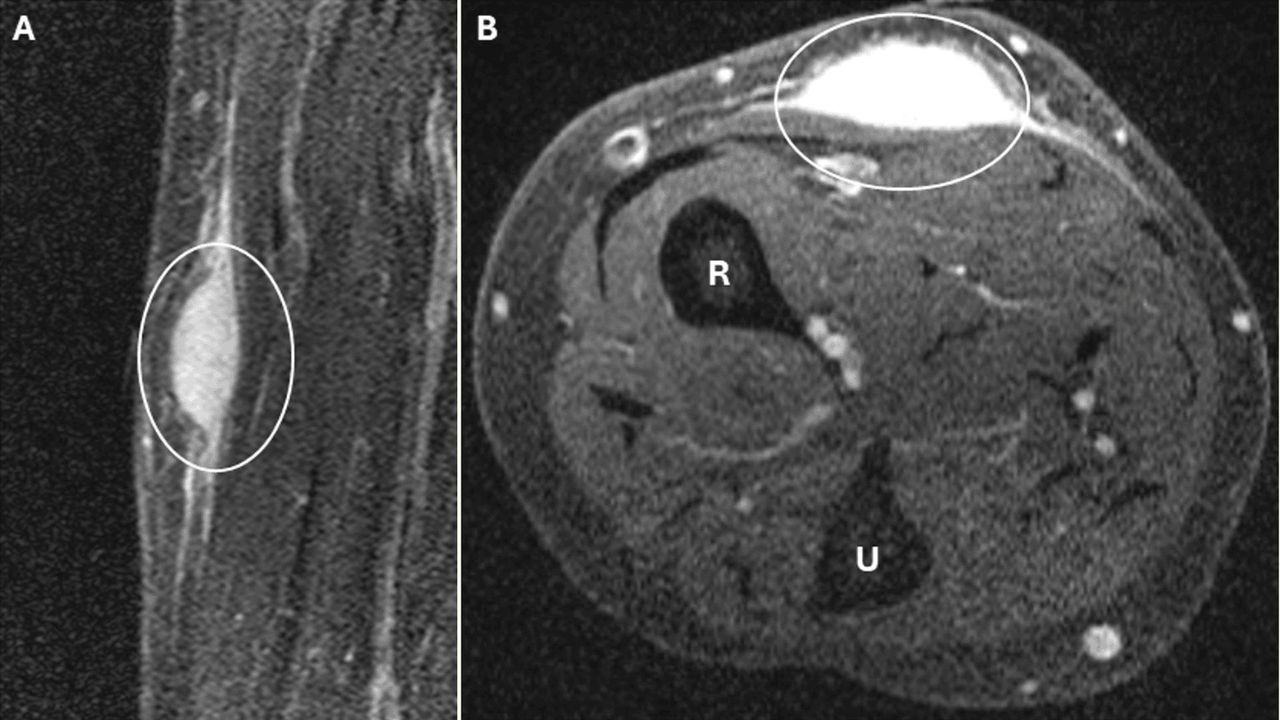 Diagnostic dilemma: Biopsy triggered ‘spontaneous regression’ of woman’s arm tumor