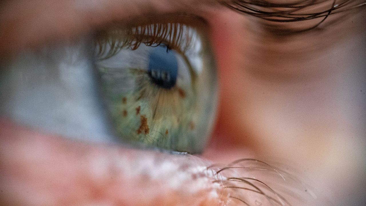 A new test could flag people at risk for anemia by filming their eyeballs — no needles required