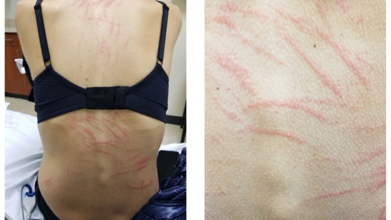 Diagnostic dilemma: Whiplike rashes appeared on a woman’s back after she ate shiitake mushrooms