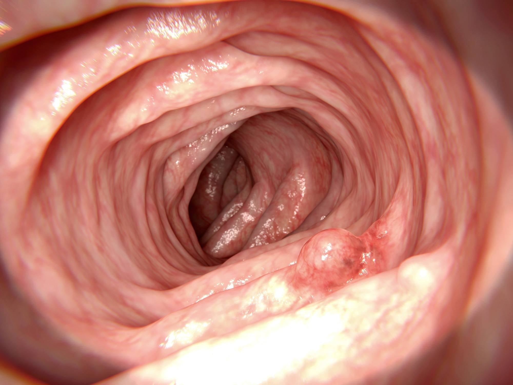 Gut changes linger years after polyp removal and may signal colorectal cancer risk