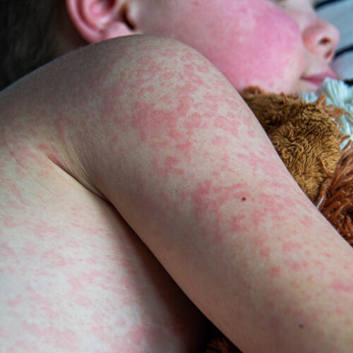 Analysis of Texas measles outbreak shows just how dangerous virus is