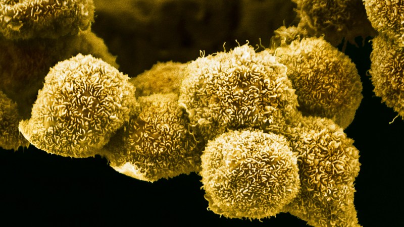 A new pancreatic cancer pill may be a game changer for patients