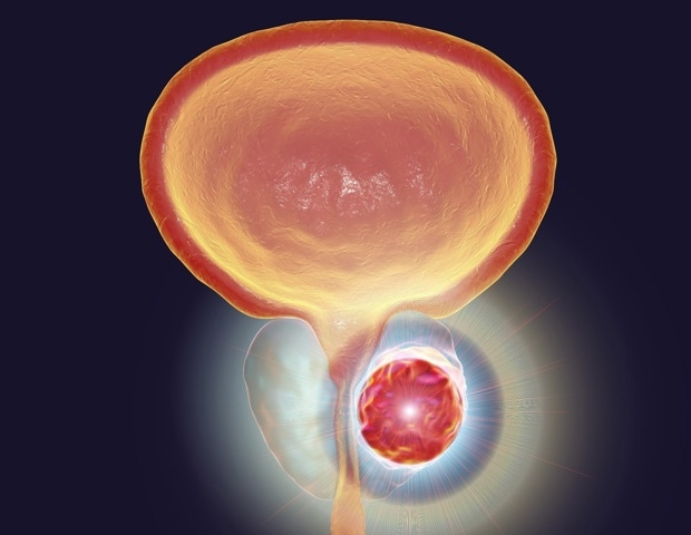High-risk prostate cancer patients benefit from perioperative apalutamide therapy