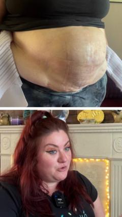‘Why I’m showing my hernia online’