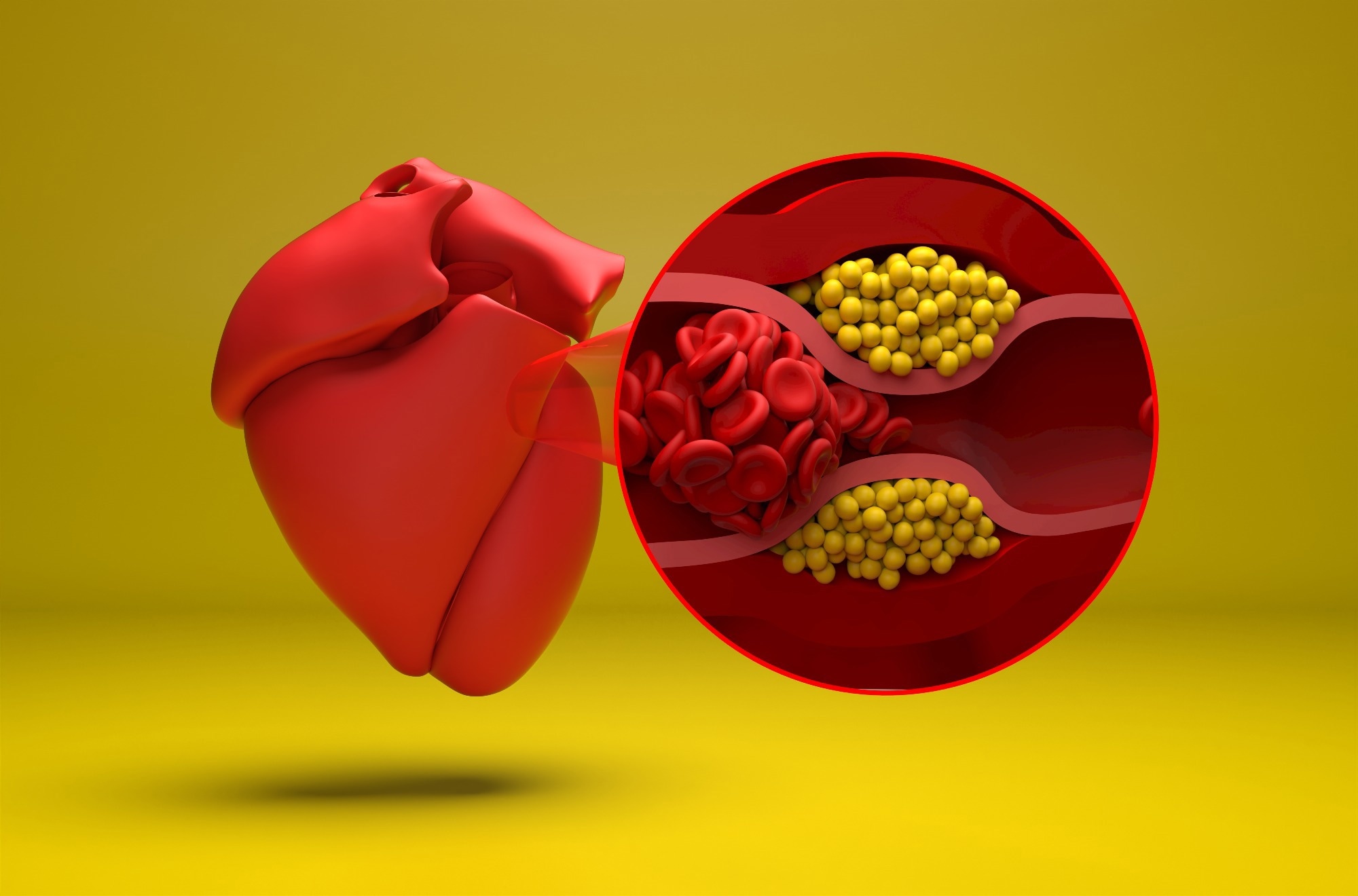 GLP-1 medicines may cut clot-related risks in chronically inflamed patients