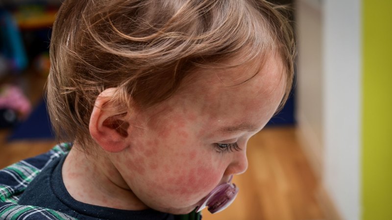 Measles has no treatments. Changing that may not be easy