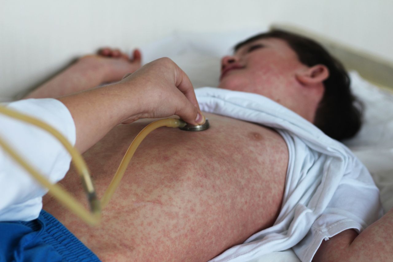 ‘This might be the point of no return’: Experts on the current measles outbreak and where we go from here