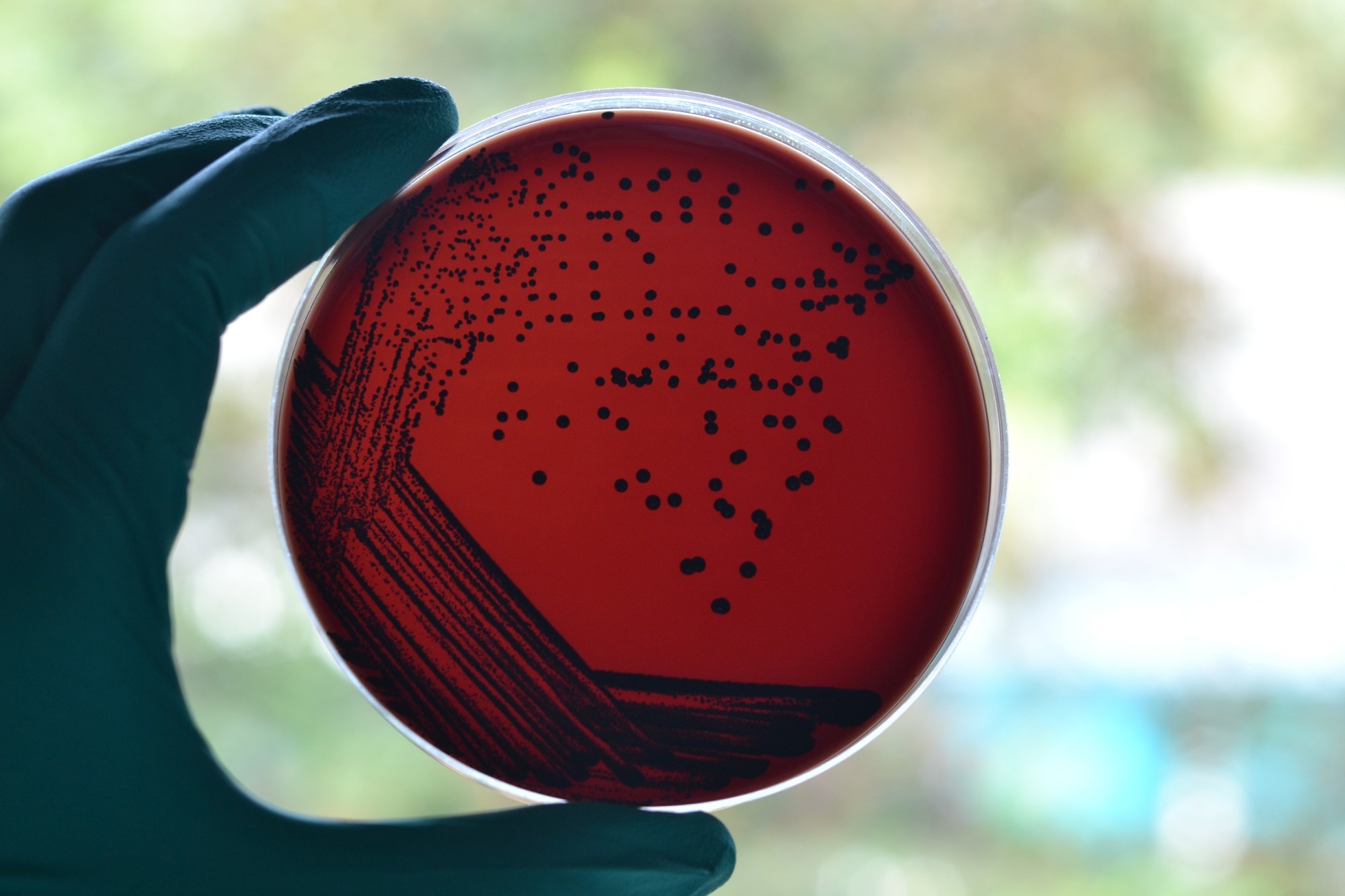 Australia’s diphtheria outbreak shows why boosters, antibiotics, and better housing all matter
