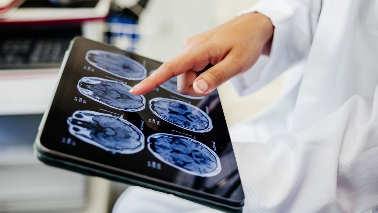 Drug-induced ‘brain freeze’ may help protect the brain after a stroke, early study suggests