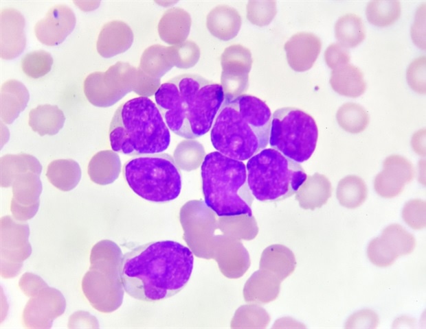 Study explains how leukemia creates inflammatory lung environments